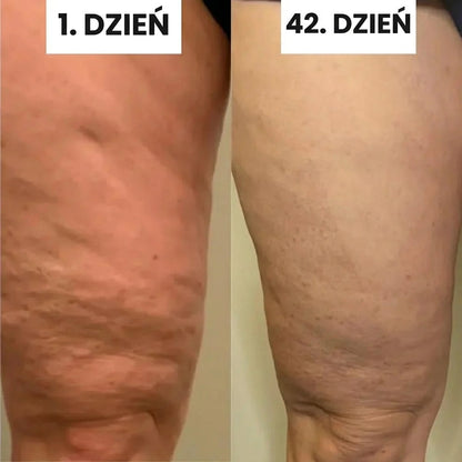 Masażer do Ciała z Technologią Wibracyjną | Skuteczna Terapia na Cellulit dla Gładkiej Skóry