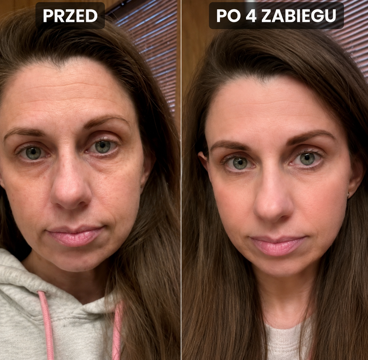 Zestaw Nawilżający Mikroinfuzji z Serum Nuvelle do Wszystkich Typów Skóry